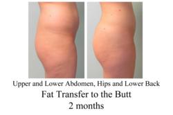 brazilian butt lift, fat transfer to butt, buttocks implants, butt augmentation